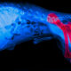 Surgery-free Treatment For Osteochondrosis Dessecans